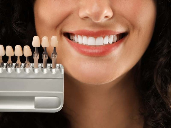 Carillas de composite